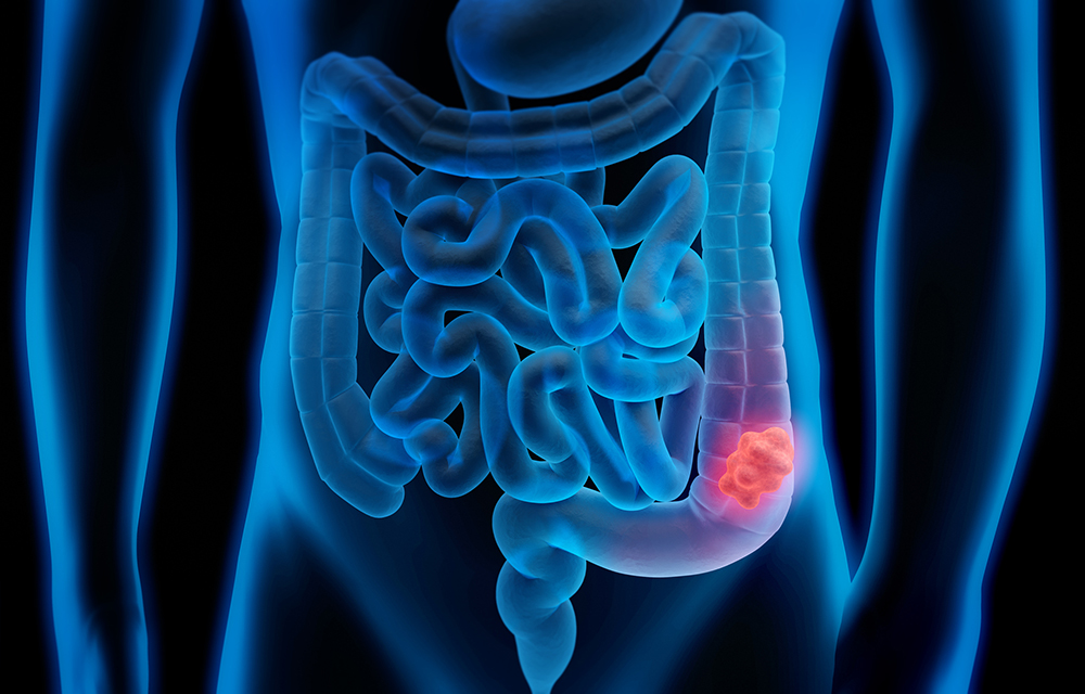 Weighing Your Colon Cancer Screening Options