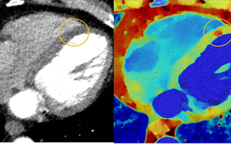 New Spectral CT Imaging Technology at Westchester Medical Center Captures Patient Scans Faster with Enhanced Clarity than Conventional CT Imaging for More Accurate Disease Diagnosis